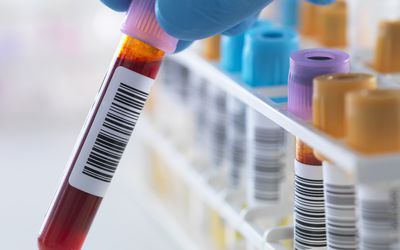 A blood sample being held with a row of human samples for analytical testing including blood, urine, chemistry, proteins, anticoagulants and HIV in lab