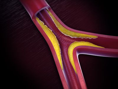 peripheral artery disease