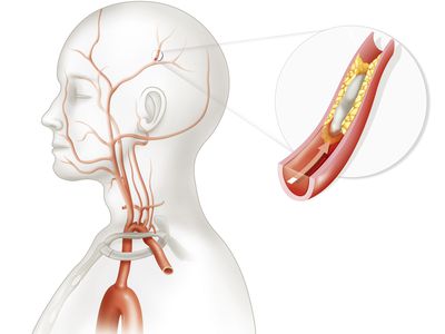 Cerebrovascular Accident