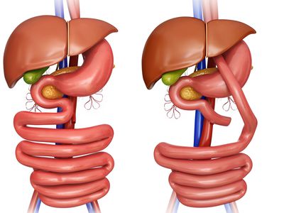 Gastric bypass, illustration