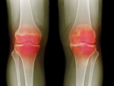 Arthritic knees, X-ray 