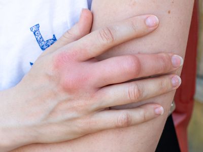 a woman with a swelling finger