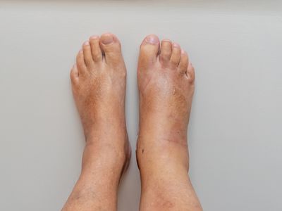 swollen feet and ankles