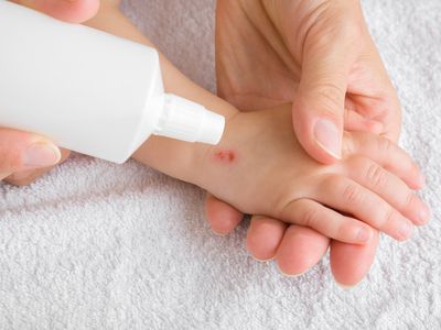 A woman cleaning a child's abrasion