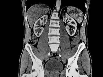 Abdominal CT san