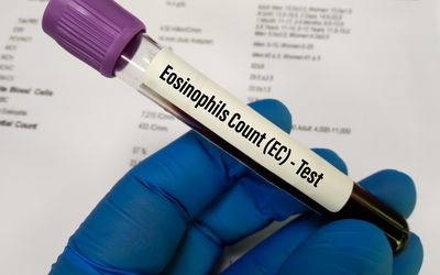 Gloved hand holding a blood draw tube with the label "eosinophils count (EC) test". 