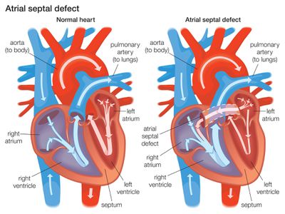 Diagram demonstrating the difference between a normal heart and a heart with an atrial septal defect