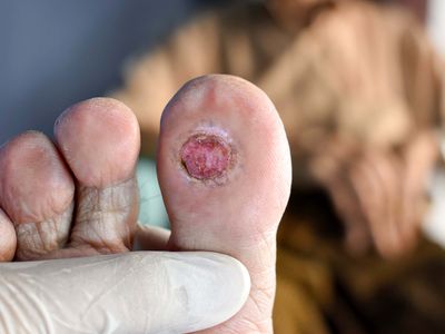 diabetic foot ulcer