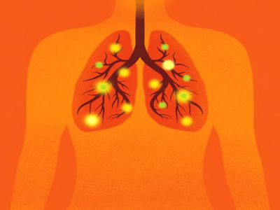 Illustration of human chest with lungs with pathogens inside, shades of red and orange.