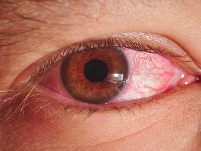 Pink eye, or conjunctivitis seen in an eye.