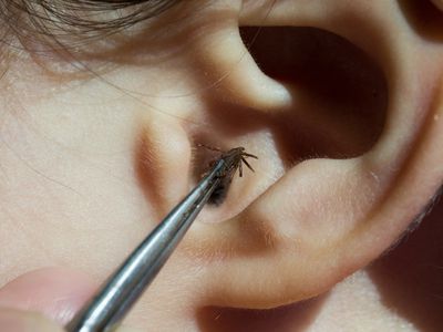 Close-Up Of Insect In Tweezers Over Human Ear - stock photo