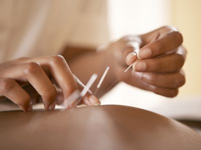 Woman getting acupuncture