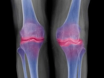 Bone spur may develop in joints damaged by arthritis.