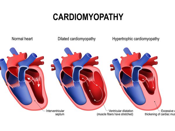 Types of heart diseases: hypertrophic cardiomyopathy and dilated cardiomyopathy. healthy heart and heart with Pathology. vector illustration for medical use