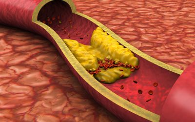 An artery clogged with plaque.