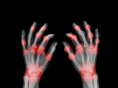 X-ray shows fingers bent from rheumatoid arthritis with painful joints highlighted in red.