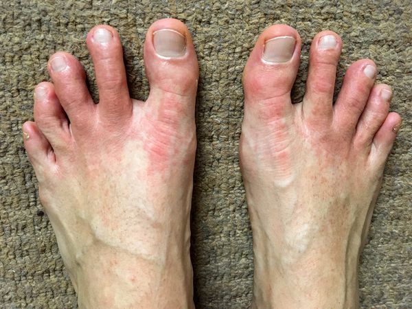 Clinical image of a COVID-19 positive patient with acral rash on toes and dorsal feet appearing two days after confirmed SARS-CoV-2 test. 