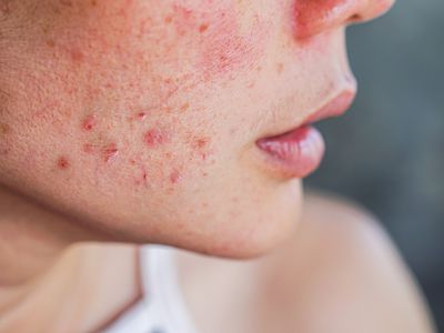 Close up of acne and rash on a person's face