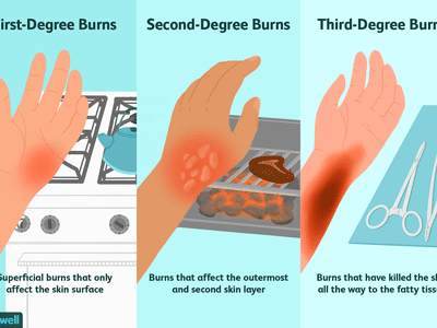 Degrees of Burns