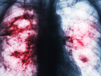 x-ray of lungs with scarring