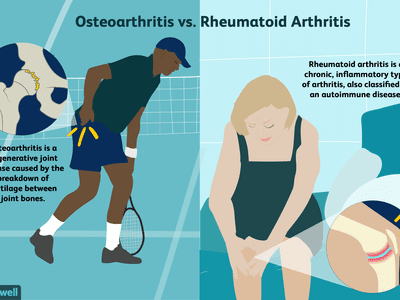 Osteoarthritis vs. Rheumatoid Arthritis